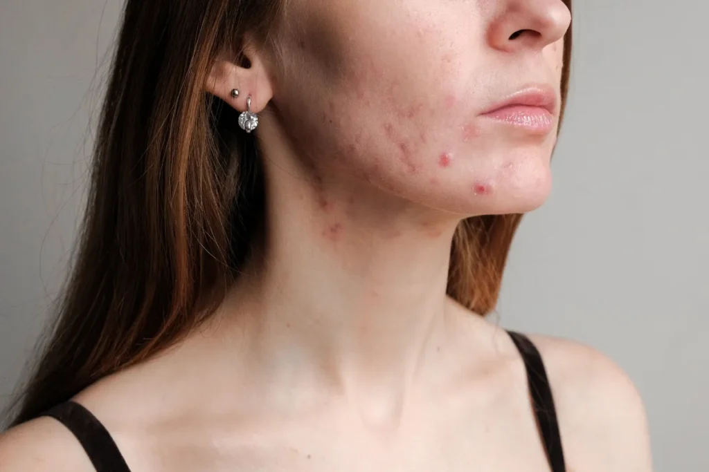 acne