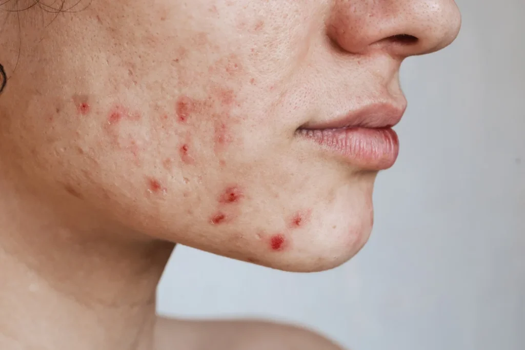 acne-treatment