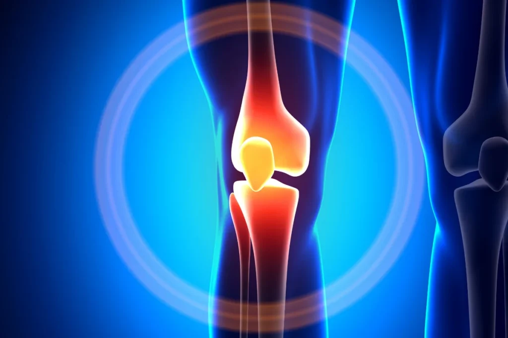 patellofemoral pain syndrome