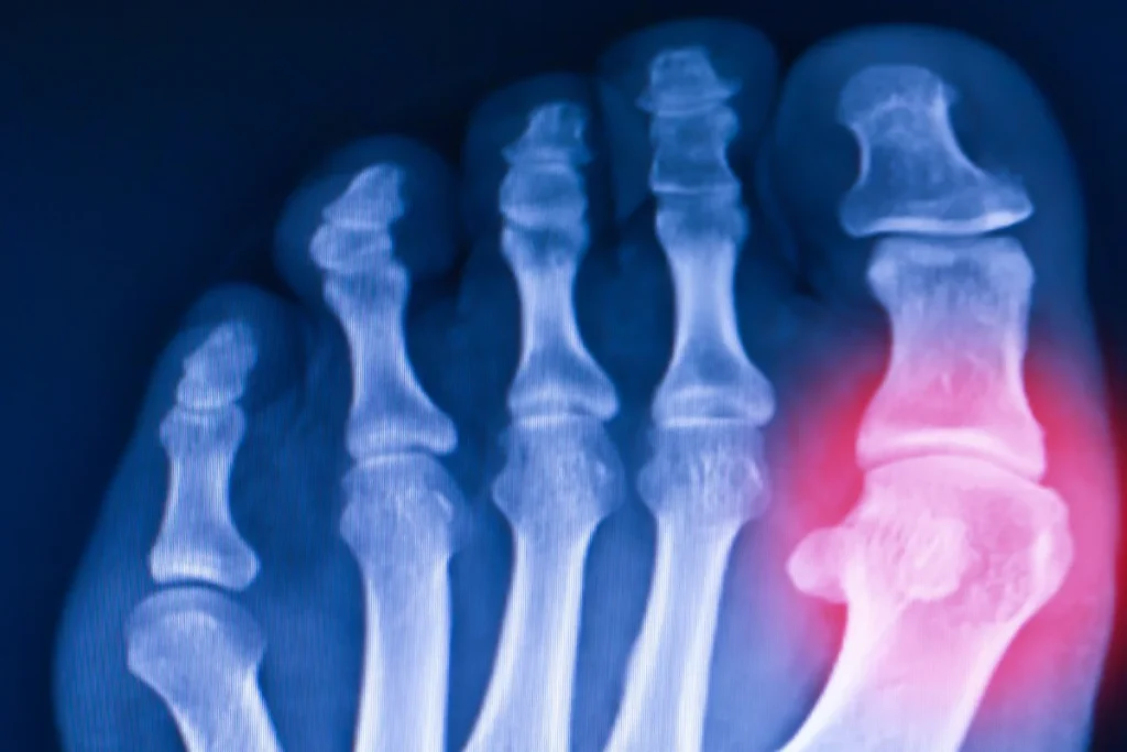 toe arthritis
