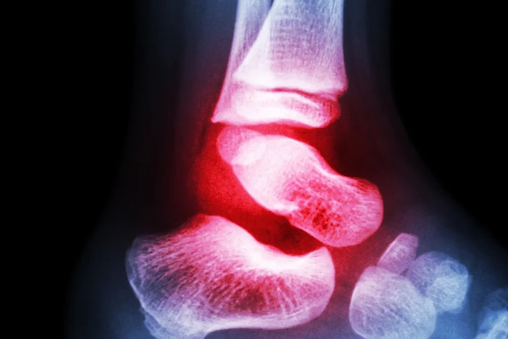 rheumatoid arthritis and low testosterone