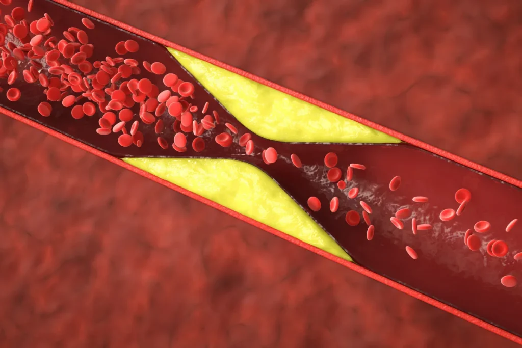 Cholesterol and Plasmapheresis