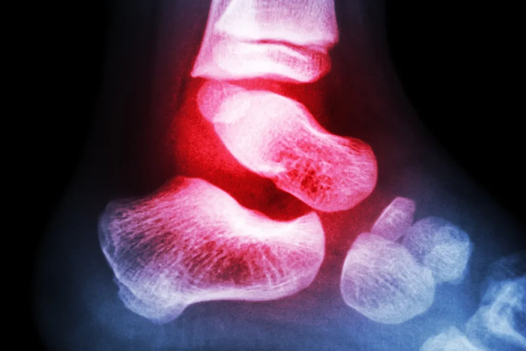 Subtalar Arthritis
