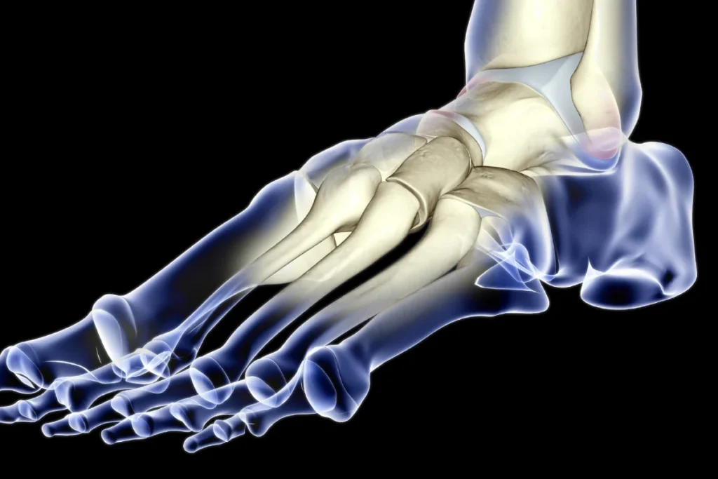 navicular subluxation
