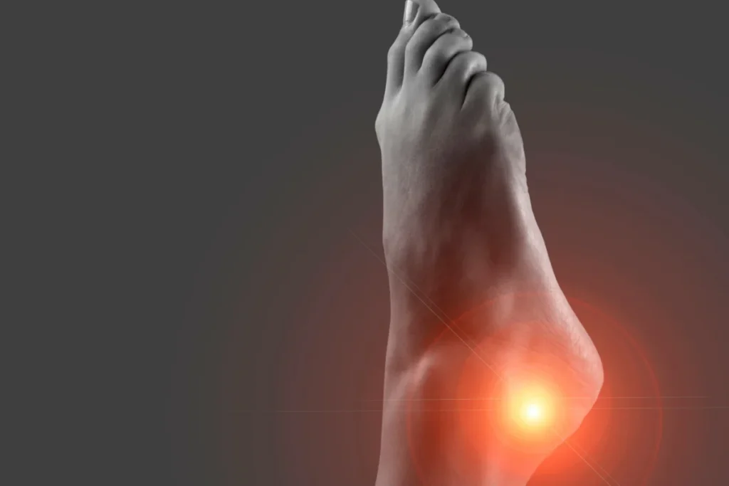 tarsal tunnel syndrome